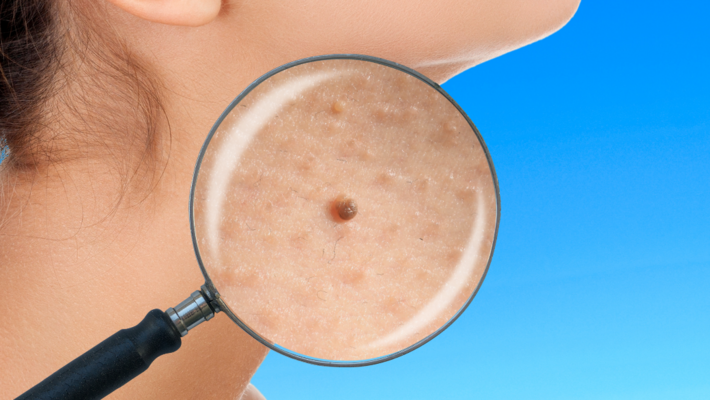 Check What Kind of Neck Skin Tag is Abnormal and Cancerous