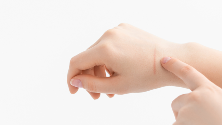 How to care for the wound Let there be as little scar as possible.